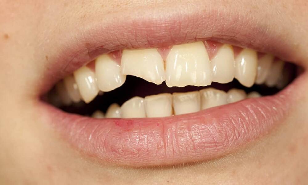 تعرف على 7 عادات سيئة ستضر بـــ اسنانك !!
