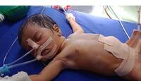 في حالة غريبة .. ولادة طفلة تحمل داخل معدتها 8 أجنة في الهند